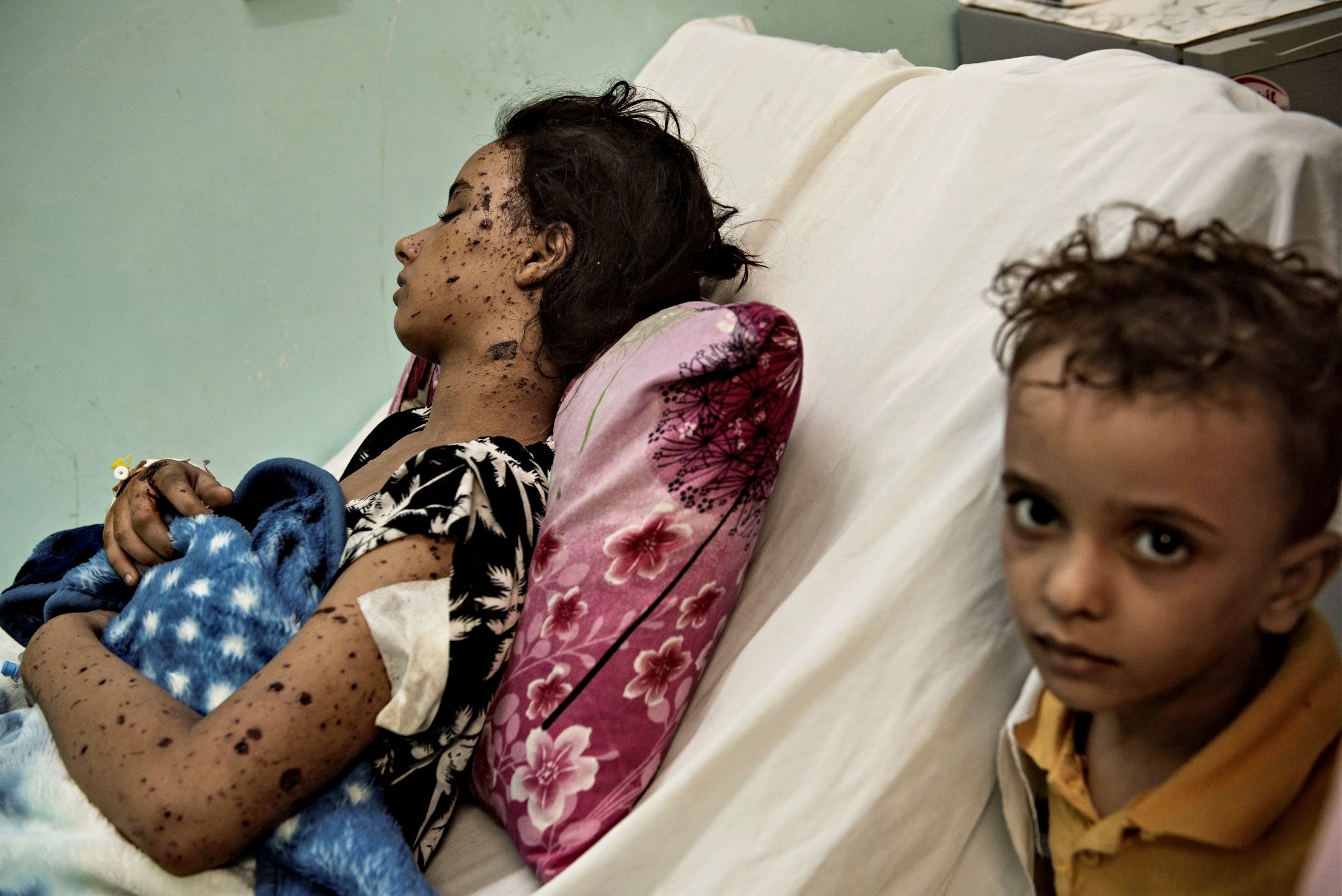 Girl in hospital in Hodeidah, Yemen (Alessio Romenzi)