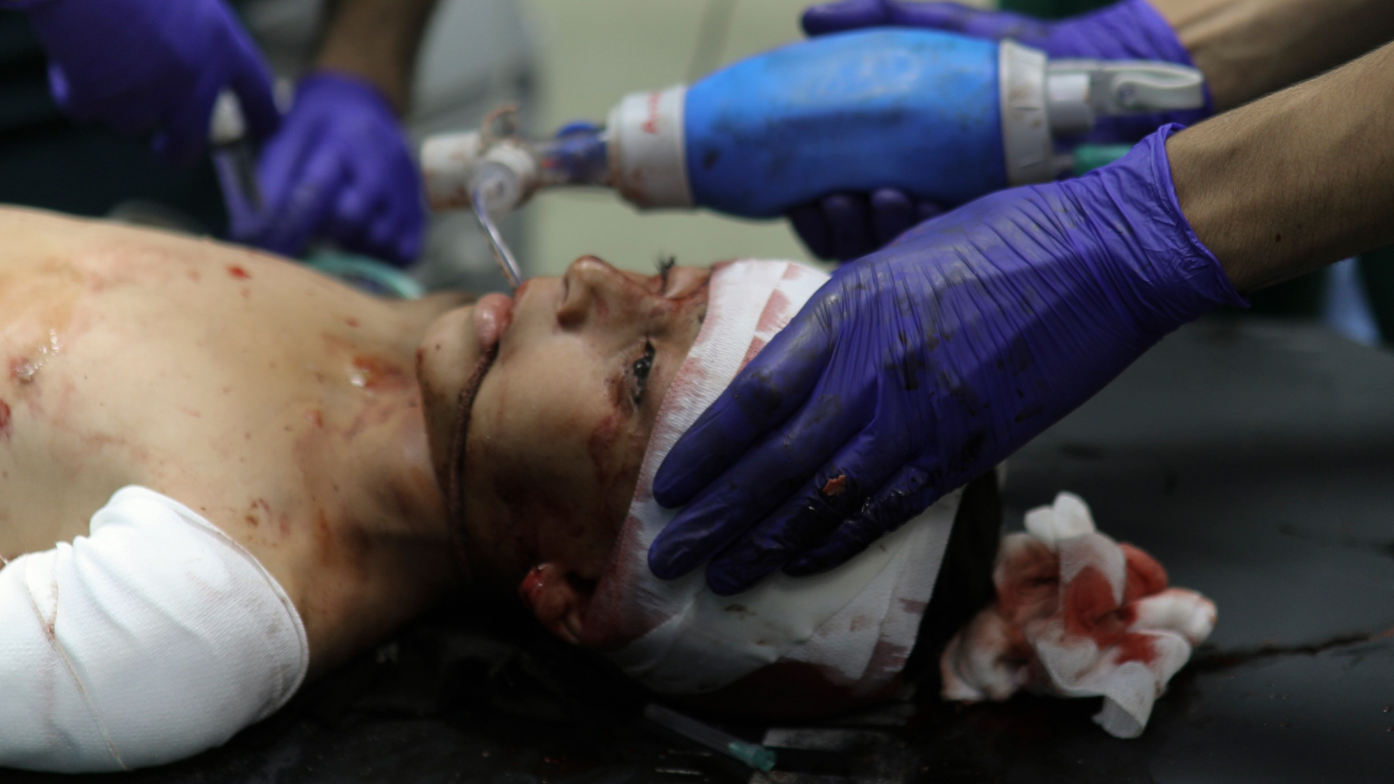 A wounded Palestinian child receives medical treatment at the Nasser Hospital following Israeli bombardment on Khan Younis refugee camp on November 2023 (AP)
