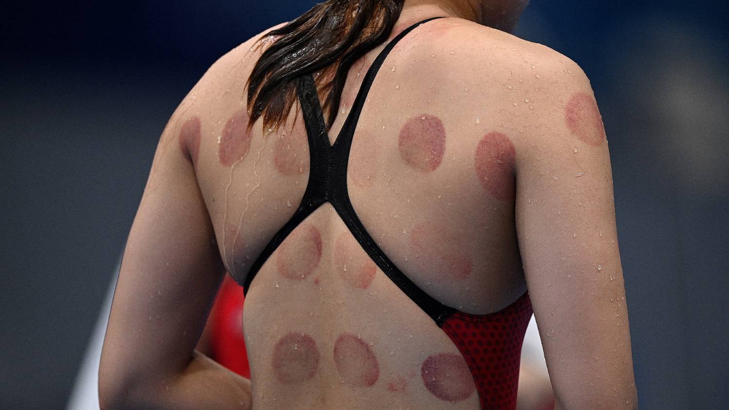 Cupping has become a form of competitive healing as athletes use the treatment to heal faster and quicker (AFP/Oli Scarff)