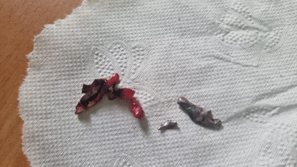 Fragments of bullets that hit Zakaria al-Adra when he was shot at close range by settlers in Atuwani on 12 October (Mohammad al-Huraini)