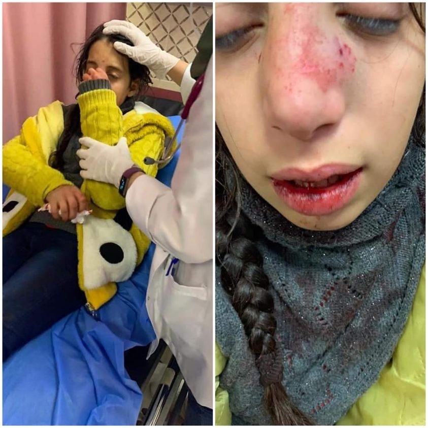 Hala Qat, an 11-year-old girl from Madama, after being attacked by Israeli settlers (Social media)